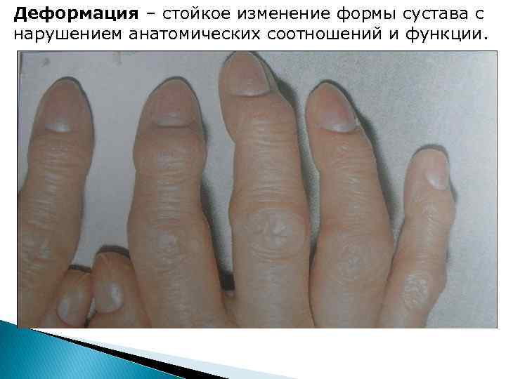 Деформация – стойкое изменение формы сустава с нарушением анатомических соотношений и функции. 