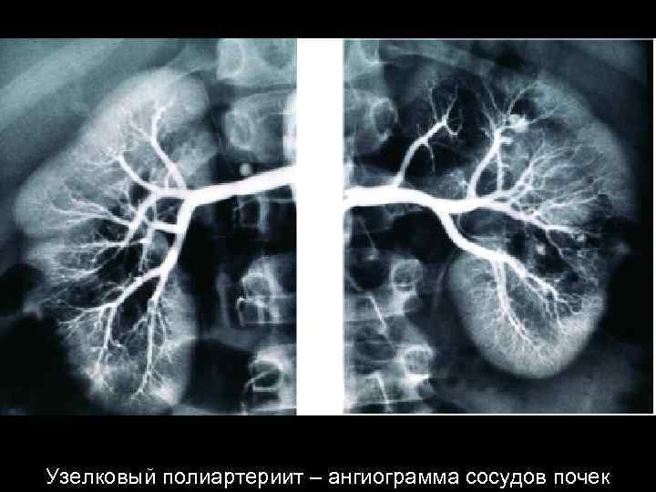 Узелковый полиартериит – ангиограмма сосудов почек 