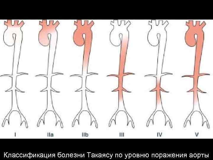 Классификация болезни Такаясу по уровню поражения аорты 