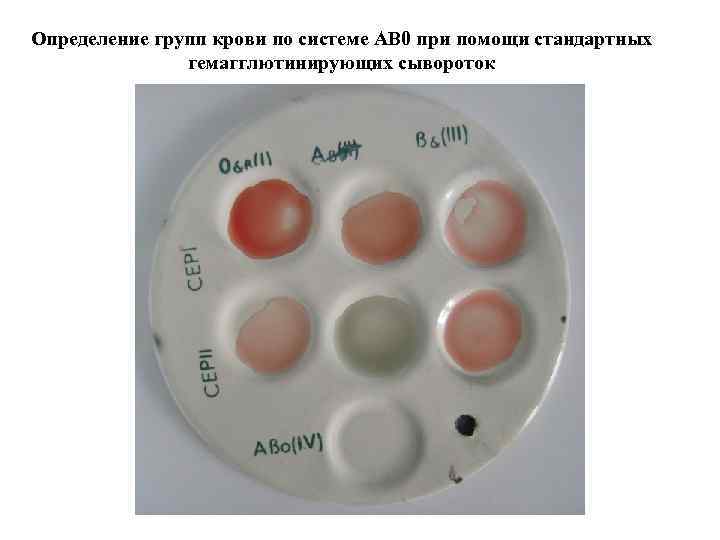 Определение групп крови по системе АВ 0 при помощи стандартных гемагглютинирующих сывороток 