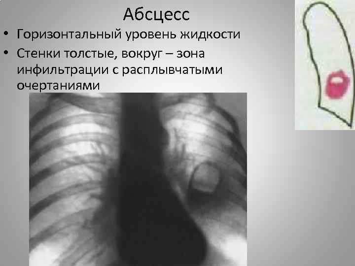 Абсцесс • Горизонтальный уровень жидкости • Стенки толстые, вокруг – зона инфильтрации с расплывчатыми