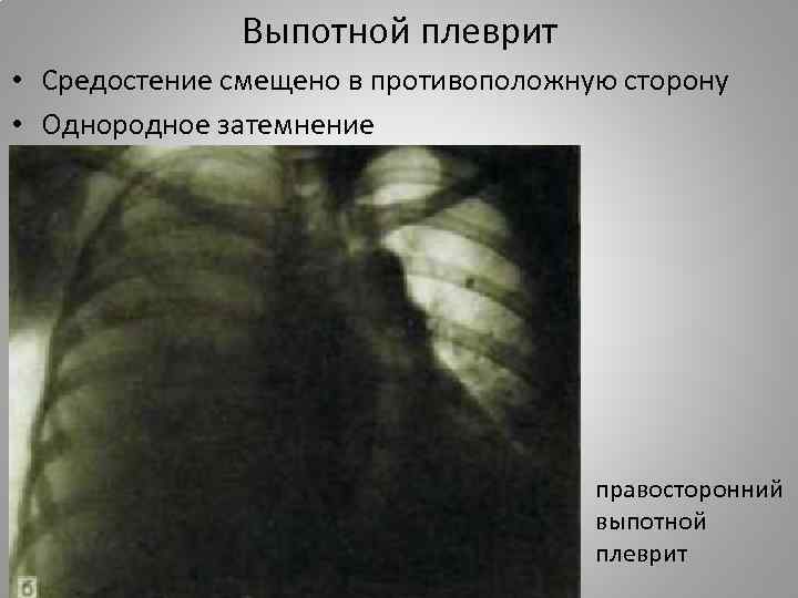 Выпотной плеврит • Средостение смещено в противоположную сторону • Однородное затемнение правосторонний выпотной плеврит