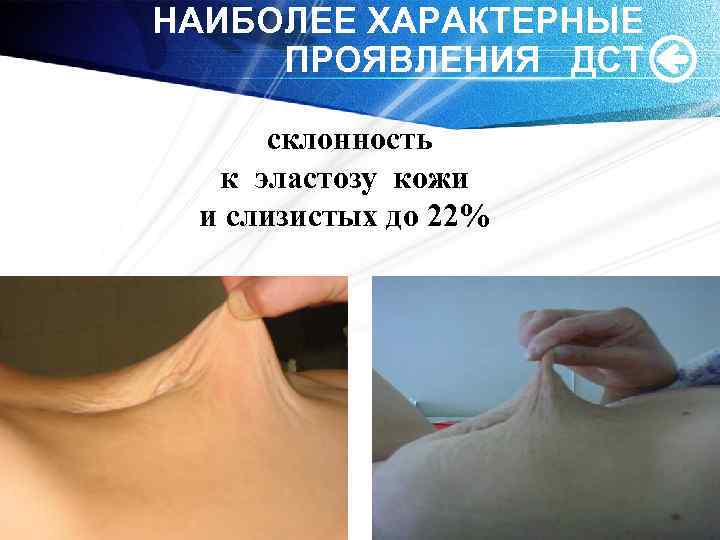 НАИБОЛЕЕ ХАРАКТЕРНЫЕ ПРОЯВЛЕНИЯ ДСТ склонность к эластозу кожи и слизистых до 22% 