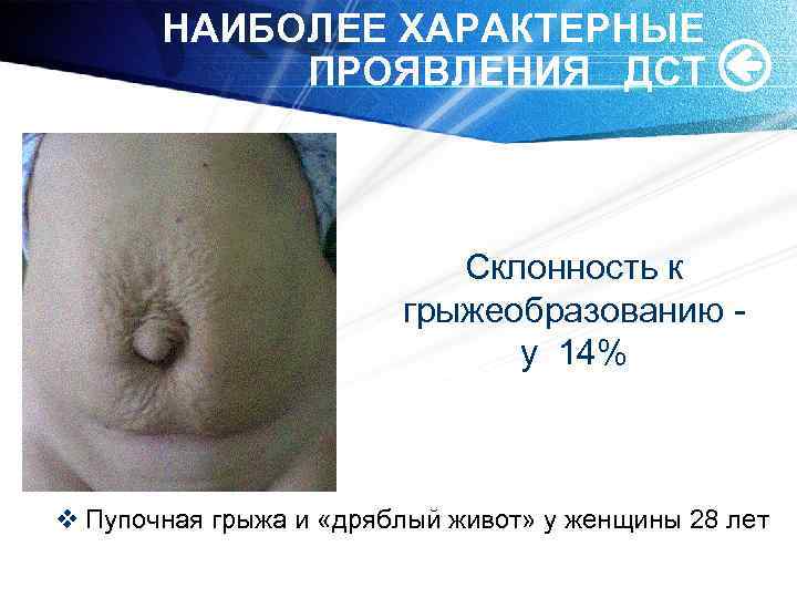НАИБОЛЕЕ ХАРАКТЕРНЫЕ ПРОЯВЛЕНИЯ ДСТ Склонность к грыжеобразованию у 14% v Пупочная грыжа и «дряблый