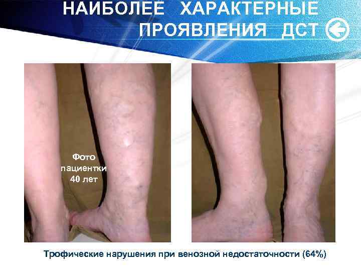 НАИБОЛЕЕ ХАРАКТЕРНЫЕ ПРОЯВЛЕНИЯ ДСТ Фото пациентки 40 лет Трофические нарушения при венозной недостаточности (64%)