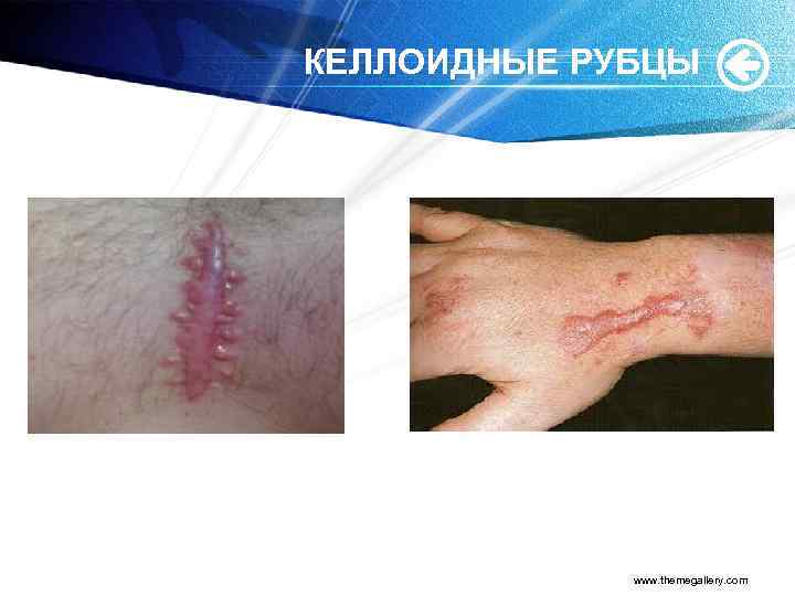 КЕЛЛОИДНЫЕ РУБЦЫ www. themegallery. com 