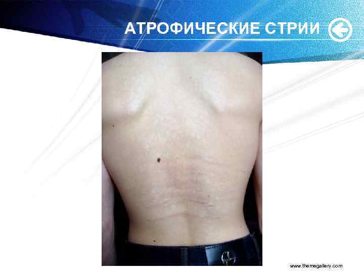 АТРОФИЧЕСКИЕ СТРИИ www. themegallery. com 