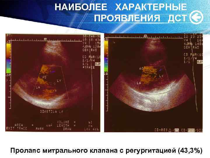 НАИБОЛЕЕ ХАРАКТЕРНЫЕ ПРОЯВЛЕНИЯ ДСТ Пролапс митрального клапана с регургитацией (43, 3%) 
