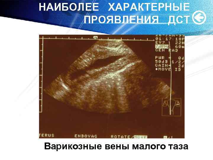 НАИБОЛЕЕ ХАРАКТЕРНЫЕ ПРОЯВЛЕНИЯ ДСТ Варикозные вены малого таза 