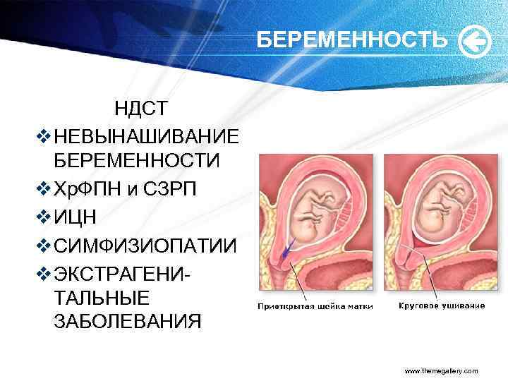 БЕРЕМЕННОСТЬ НДСТ v НЕВЫНАШИВАНИЕ БЕРЕМЕННОСТИ v Хр. ФПН и СЗРП v ИЦН v СИМФИЗИОПАТИИ
