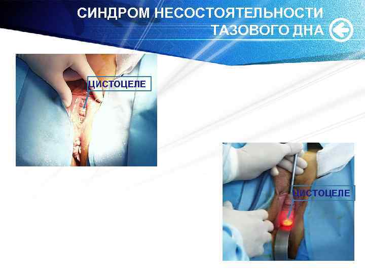 СИНДРОМ НЕСОСТОЯТЕЛЬНОСТИ ТАЗОВОГО ДНА ЦИСТОЦЕЛЕ 