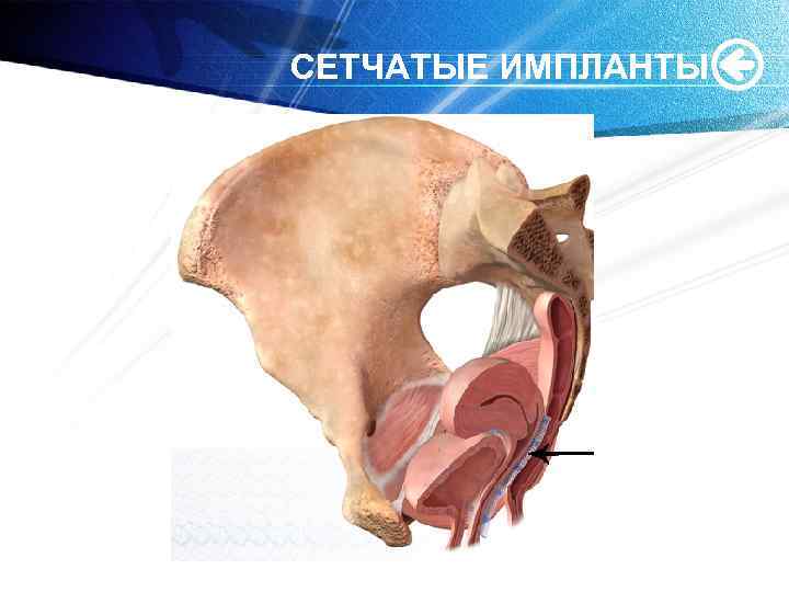 СЕТЧАТЫЕ ИМПЛАНТЫ 