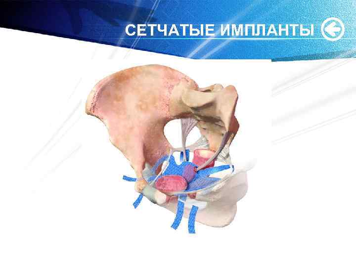 СЕТЧАТЫЕ ИМПЛАНТЫ 