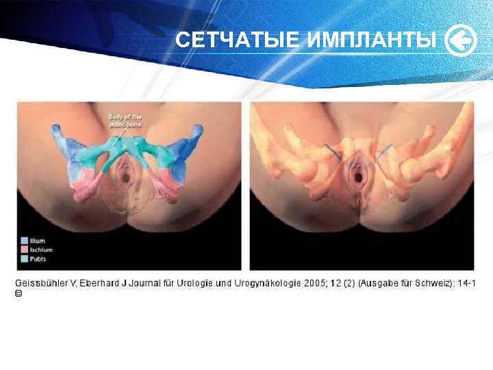 СЕТЧАТЫЕ ИМПЛАНТЫ 