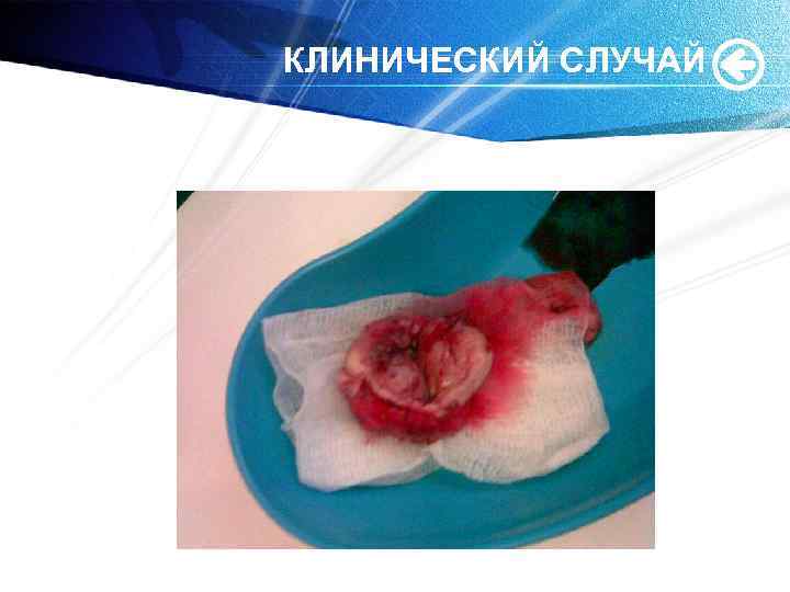 КЛИНИЧЕСКИЙ СЛУЧАЙ 