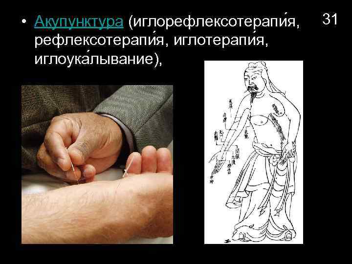  • Акупунктура (иглорефлексотерапи я, иглотерапи я, иглоука лывание), 31 