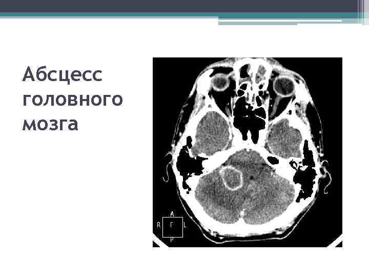 Абсцесс головного мозга 