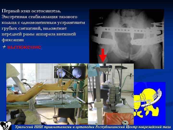 Первый этап остеосинтеза. Экстренная стабилизация тазового кольца с одномоментным устранением грубых смещений, наложение передней