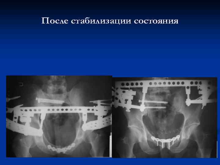 После стабилизации состояния 
