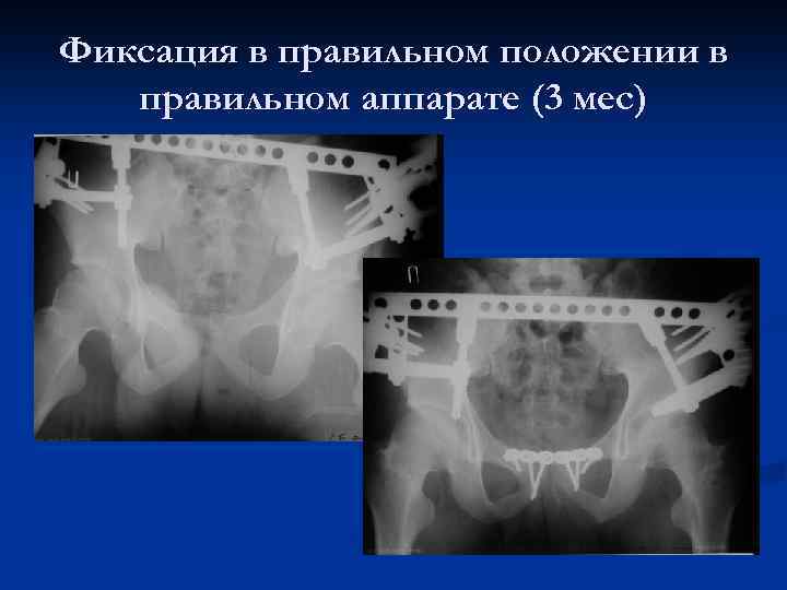 Фиксация в правильном положении в правильном аппарате (3 мес) 