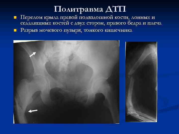 Компенсация дтп перелом лонной кости