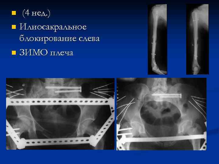 (4 нед. ) n Илиосакральное блокирование слева n ЗИМО плеча n 
