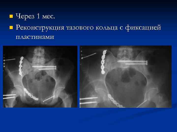 Через 1 мес. n Реконструкция тазового кольца с фиксацией пластинами n 