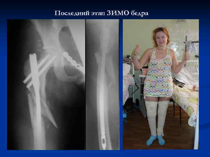 Последний этап ЗИМО бедра 