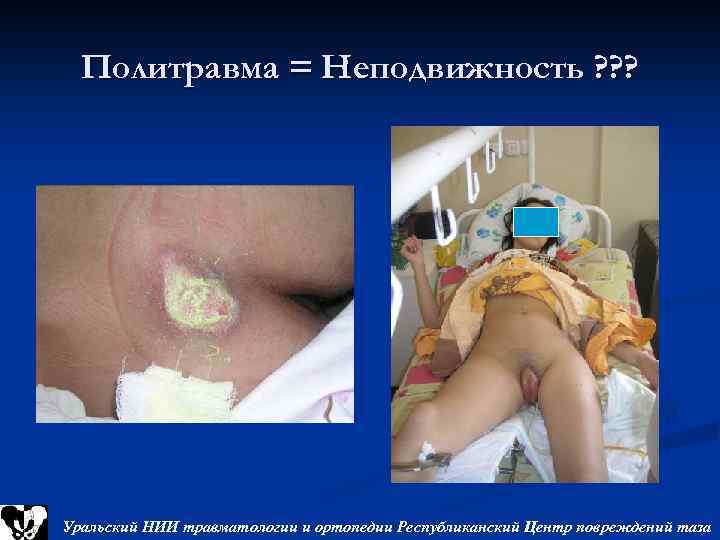 Политравма = Неподвижность ? ? ? Уральский НИИ травматологии и ортопедии Республиканский Центр повреждений