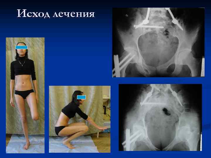 Исход лечения 