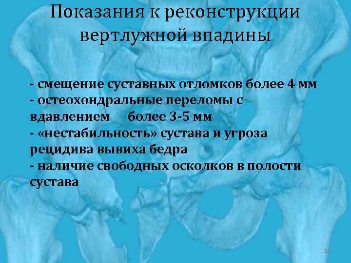 Показания к реконструкции вертлужной впадины - смещение суставных отломков более 4 мм - остеохондральные