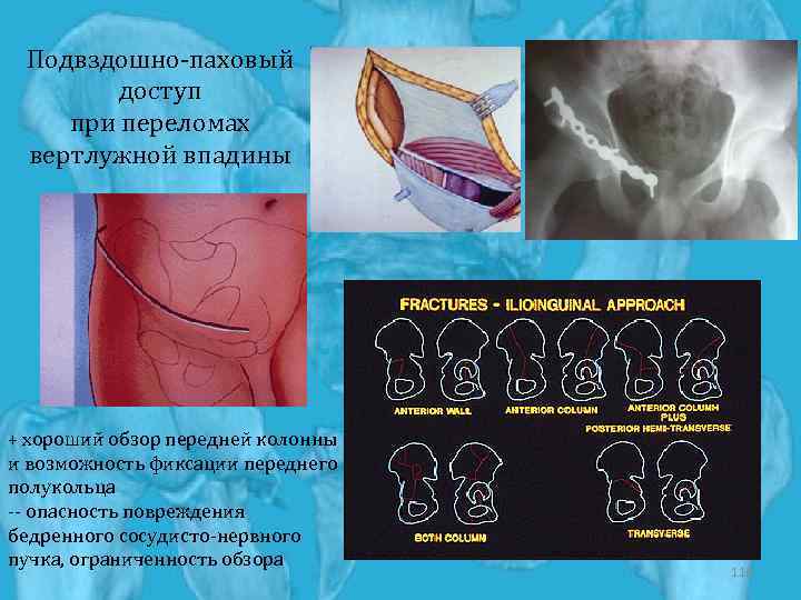 Подвздошно-паховый доступ при переломах вертлужной впадины + хороший обзор передней колонны и возможность фиксации