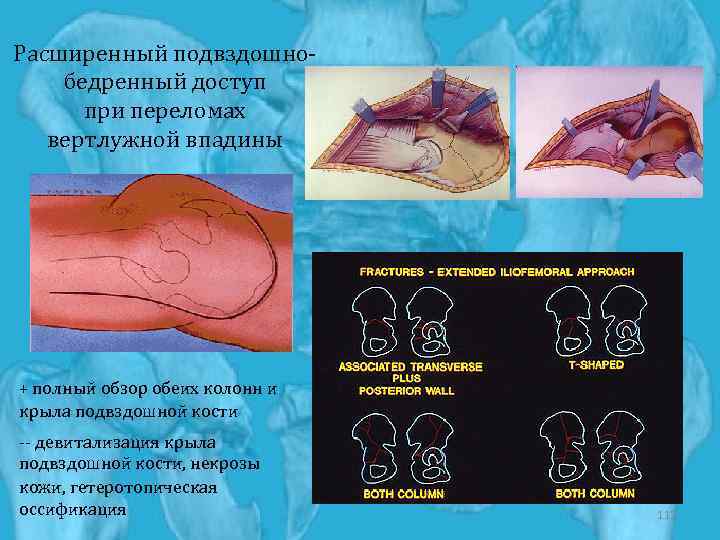 Расширенный подвздошнобедренный доступ при переломах вертлужной впадины + полный обзор обеих колонн и крыла