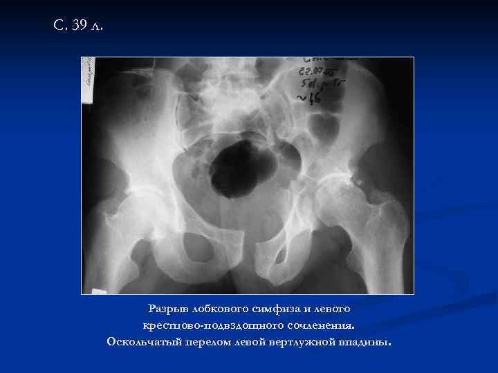 С. 39 л. Разрыв лобкового симфиза и левого крестцово-подвздощного сочленения. Оскольчатый перелом левой вертлужной