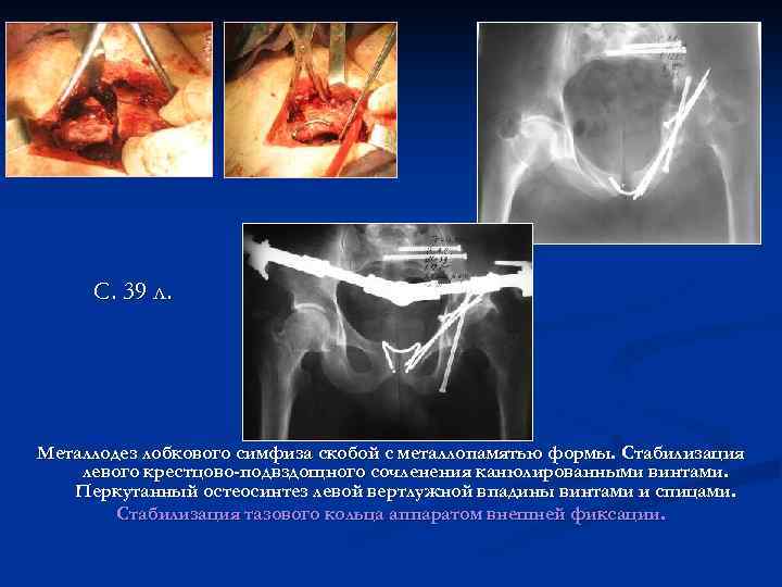 С. 39 л. Металлодез лобкового симфиза скобой с металлопамятью формы. Стабилизация левого крестцово-подвздощного сочленения