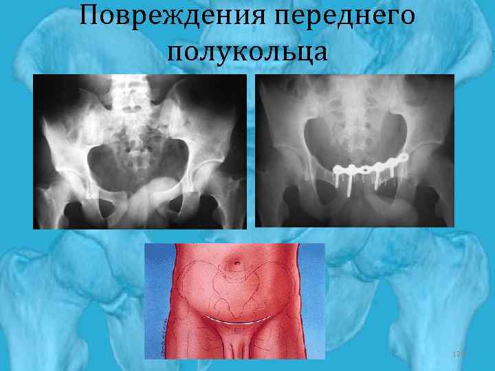 Повреждения переднего полукольца 120 