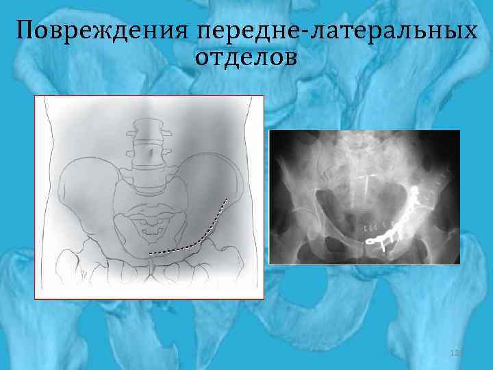 Повреждения передне-латеральных отделов 121 