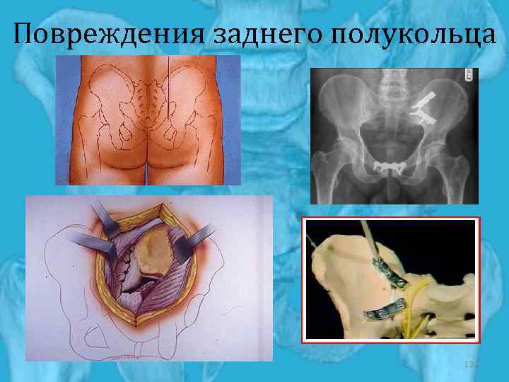 Повреждения заднего полукольца 122 