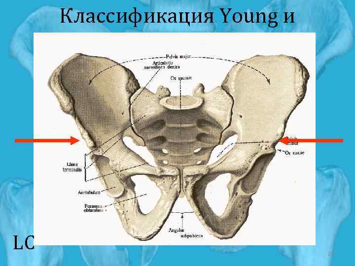 Классификация Young и Burgess LC 21 