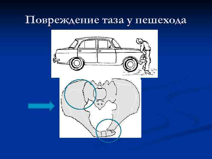 Повреждение таза у пешехода 