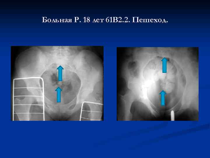 Больная Р. 18 лет 61 В 2. 2. Пешеход. 