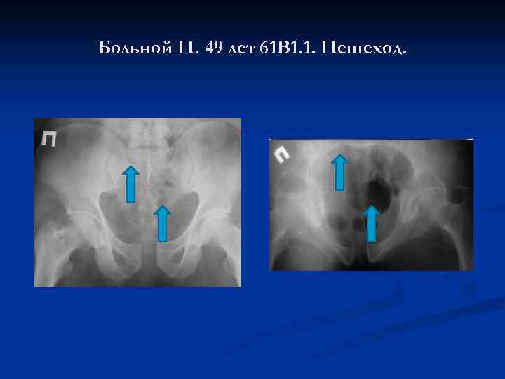 Больной П. 49 лет 61 В 1. 1. Пешеход. 