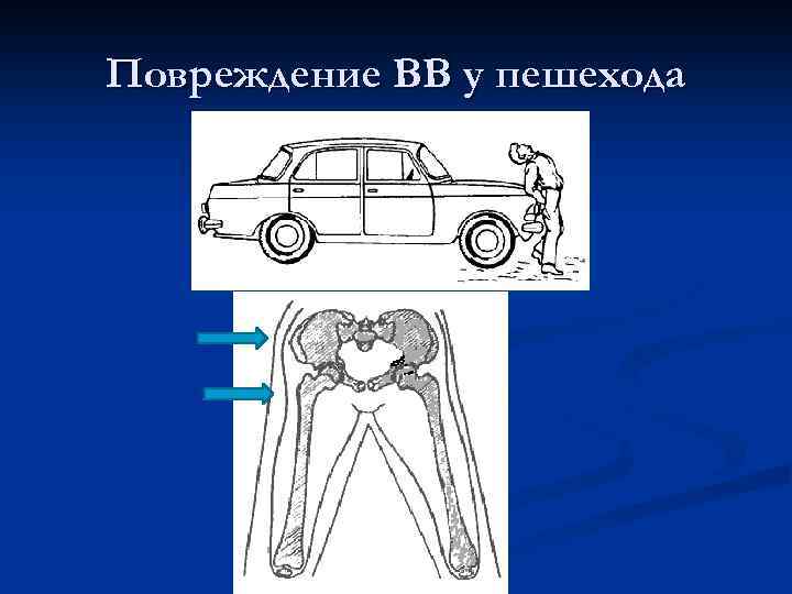 Повреждение ВВ у пешехода 