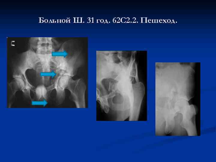 Больной Ш. 31 год. 62 С 2. 2. Пешеход. 
