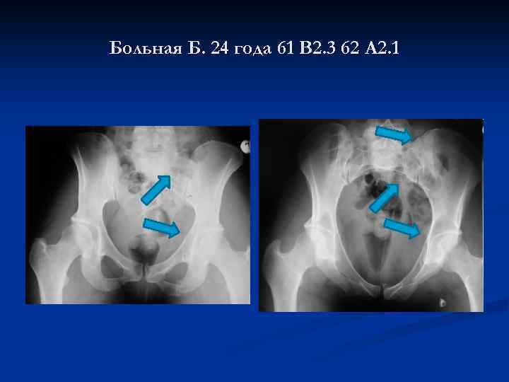 Больная Б. 24 года 61 В 2. 3 62 А 2. 1 
