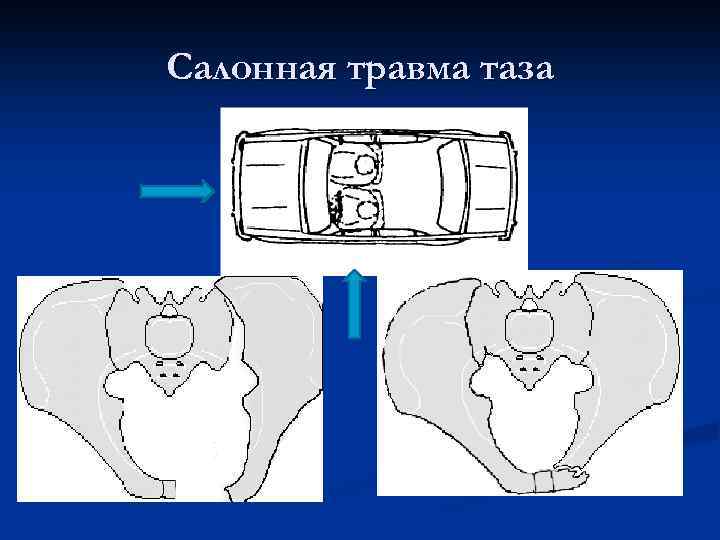 Салонная травма таза 