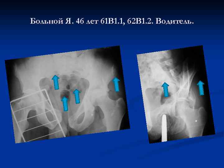 Больной Я. 46 лет 61 В 1. 1, 62 В 1. 2. Водитель. 