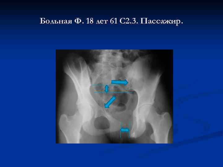 Больная Ф. 18 лет 61 С 2. 3. Пассажир. 