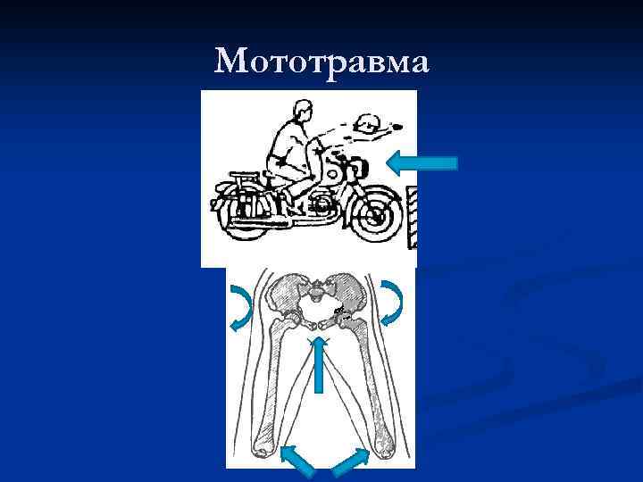 Мототравма 