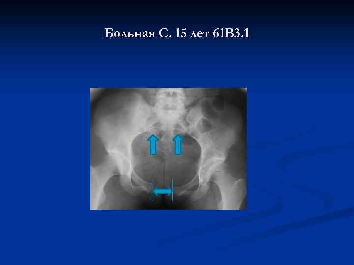 Больная С. 15 лет 61 В 3. 1 